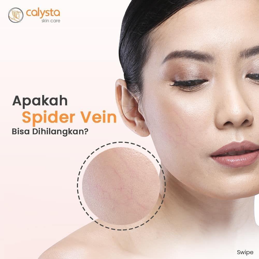 Apakah Spider Vein Bisa Dihilangkan? Apakah Spider Vein Bisa Dihilangkan?