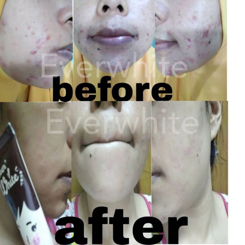 Update !! Review Testimoni Everwhite Acne Cream Update !! Review Testimoni Everwhite Acne Cream