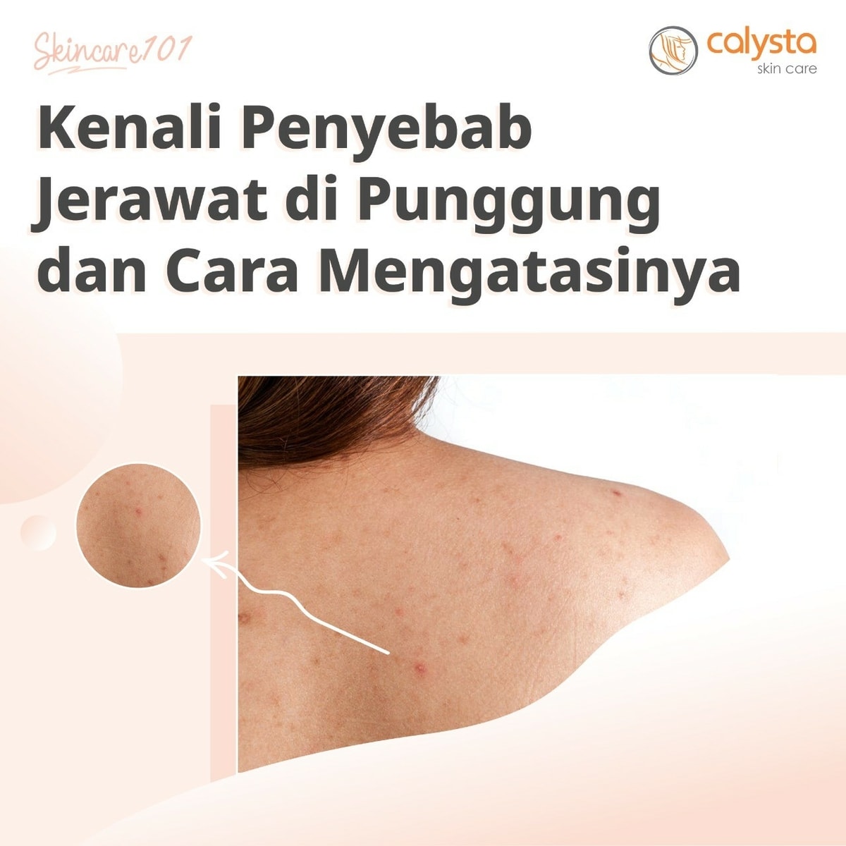 Penyebab Jerawat di Punggung dan Cara Mengatasinya Penyebab Jerawat di Punggung dan Cara Mengatasinya