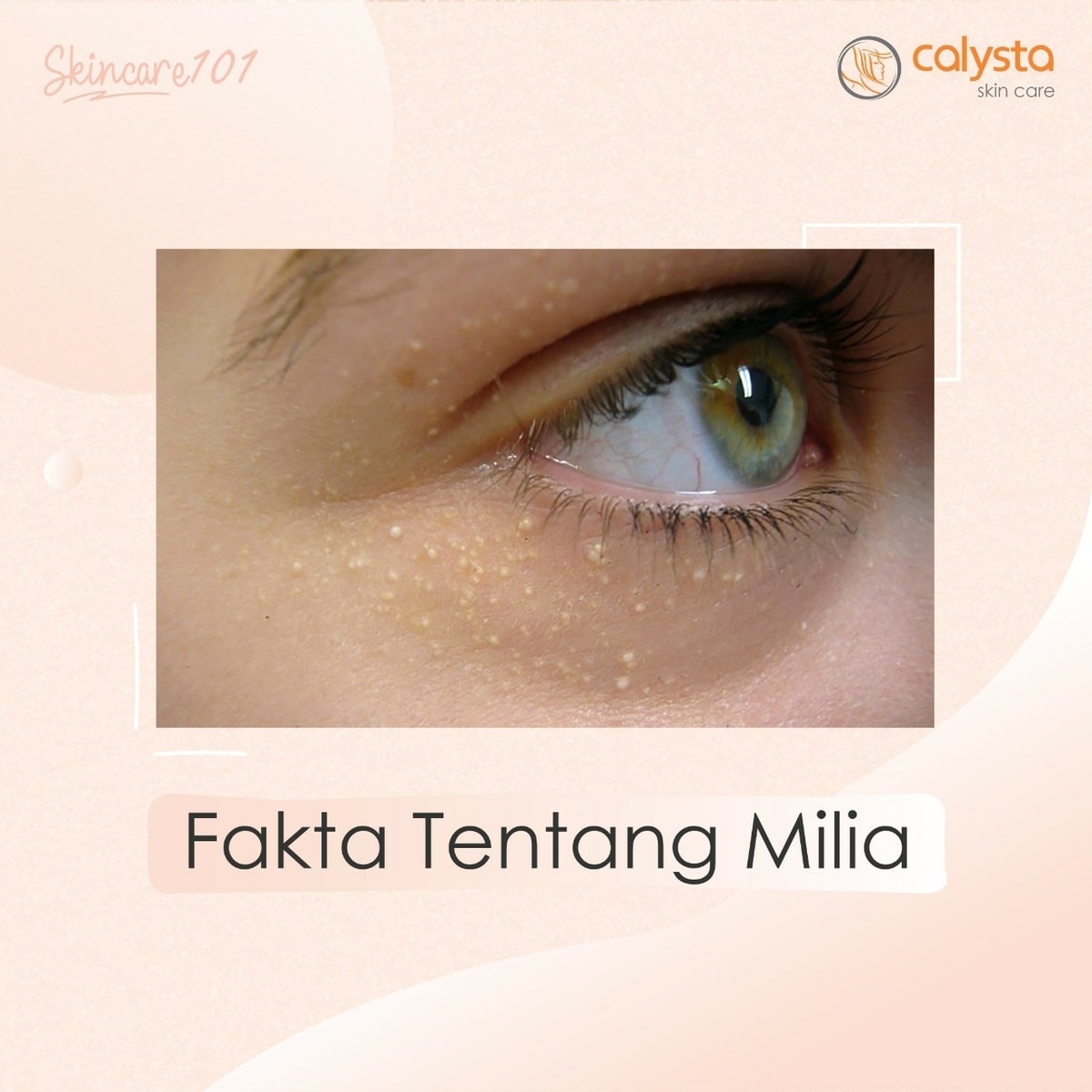 Fakta Tentang Milia Fakta Tentang Milia