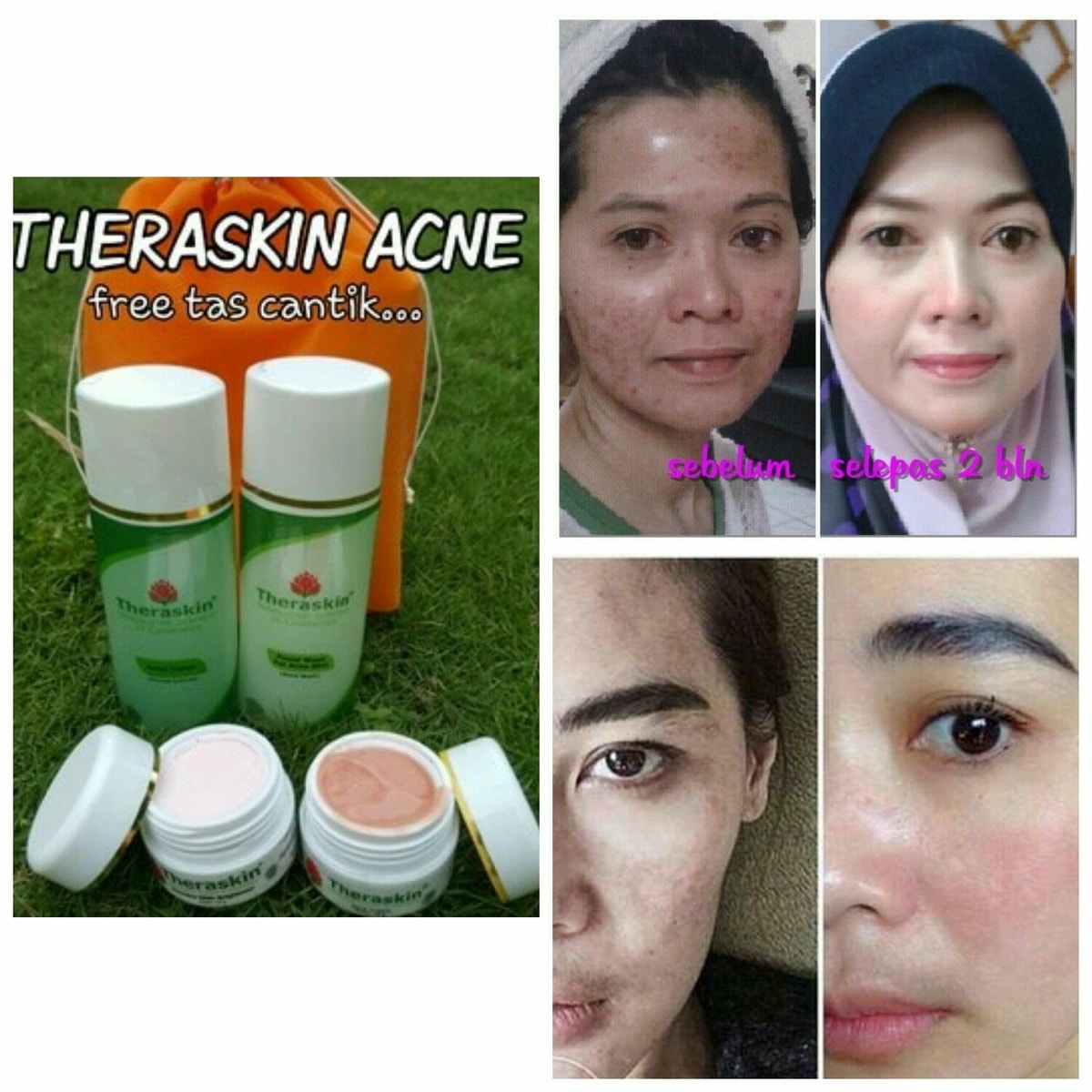Theraskin Acne Glow: Paket Khusus Jerawat + Glowing Theraskin Acne Glow: Paket Khusus Jerawat + Glowing