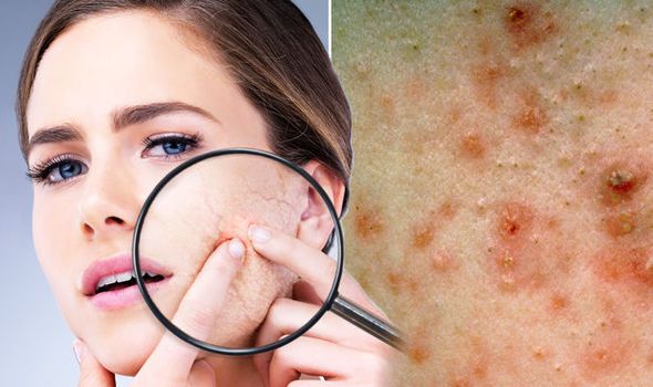 Jangan Pakai Ms Glow Acne Series, Wajah Jadi Seperti ini !! Jangan Pakai Ms Glow Acne Series, Wajah Jadi Seperti ini !!