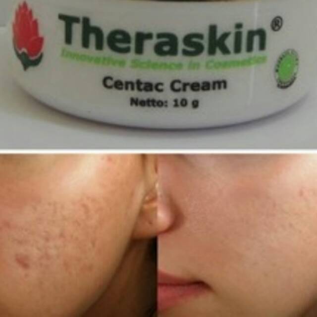 Theraskin Centac Cream: Atas Bekas Jerawat & Bopeng Theraskin Centac Cream: Atas Bekas Jerawat & Bopeng