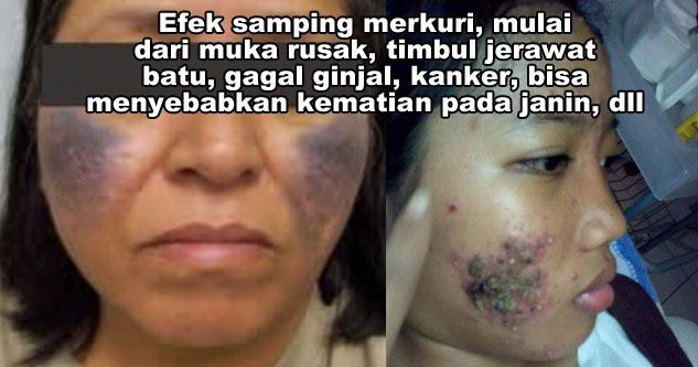 Adakah Efek Buruk Theraskin? Ternyata Sangat Berbahaya Adakah Efek Buruk Theraskin? Ternyata Sangat Berbahaya
