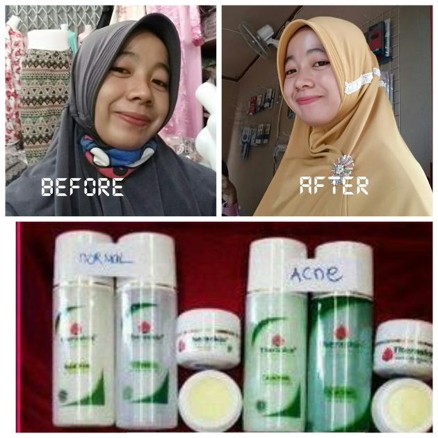 Share !! Pengalaman Memakai Theraskin !! Share !! Pengalaman Memakai Theraskin !!